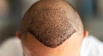 Hair Transplant in Turkey – A Timeless Medical & Travel Trend