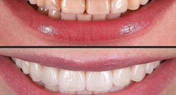 How Much For A Full Set Of Veneers?