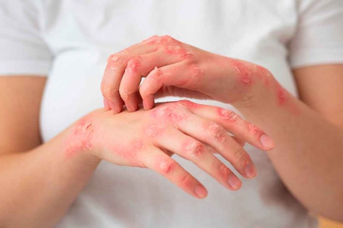 Effective Eczema Treatments